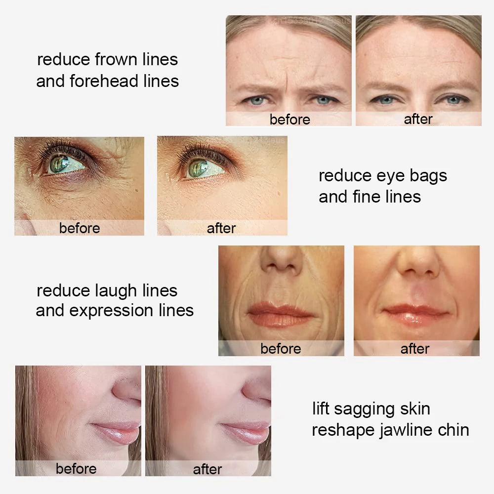 Peicon M80B Radiofrequency Face Massager – Skin Rejuvenation & Firming Tool