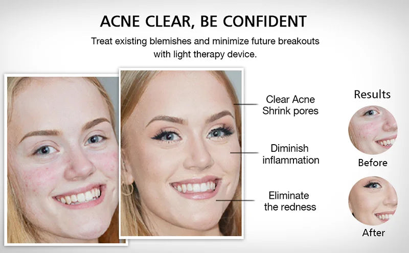 Windaily LED Face Mask with 7 Light Modes – Wireless USB Charging Beauty Therapy