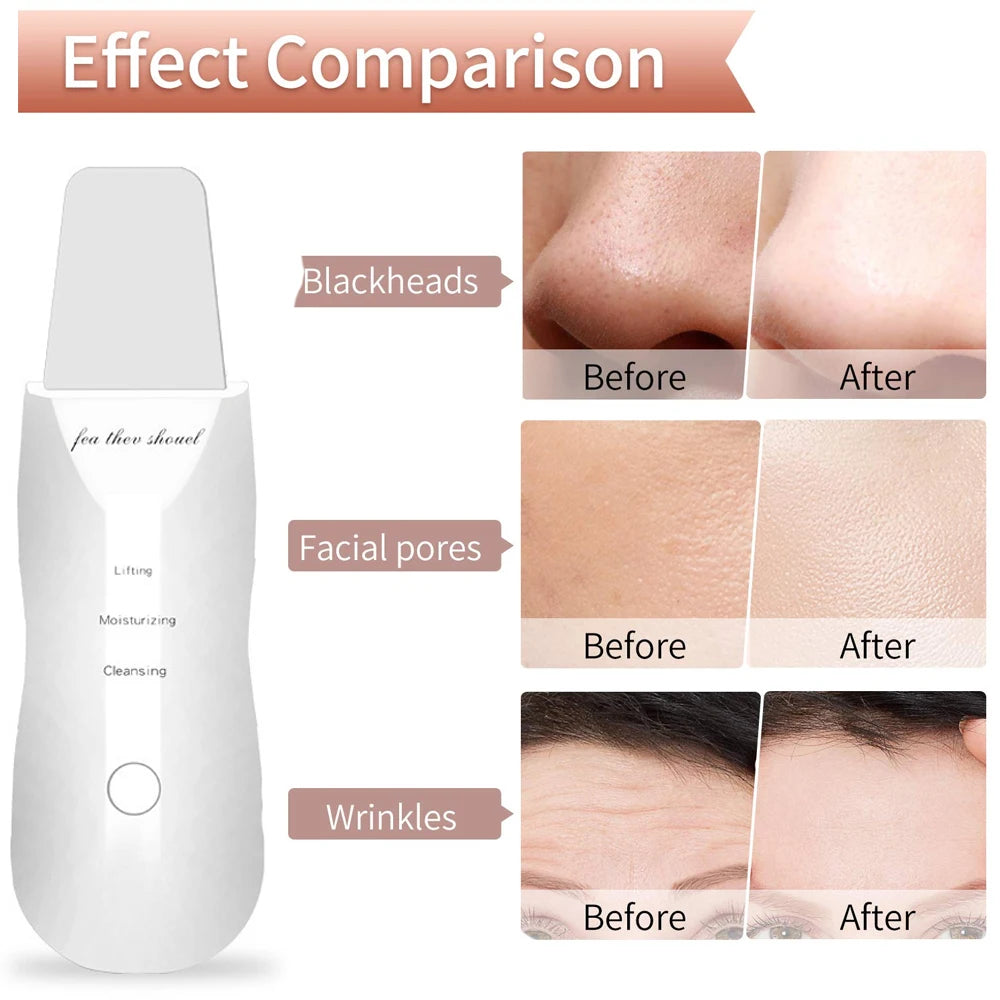 Voguish Ultrasonic Skin Scrubber – Vibration Facial Spatula Blackhead Remover