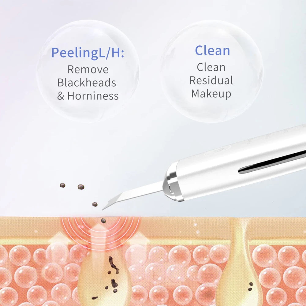 Voguish Ultrasonic Skin Scrubber – Vibration Facial Spatula Blackhead Remover