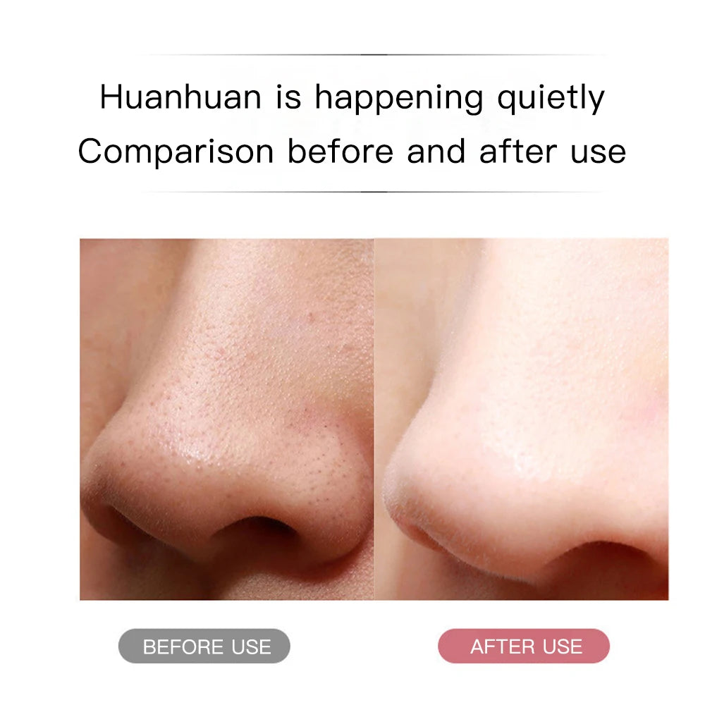 MERALL Ultrasonic Skin Scrubber – EMS Ion Deep Pore Facial Cleaner